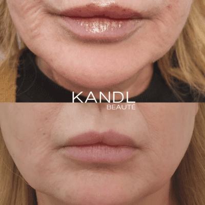 Joy-Microneedling In Montreal