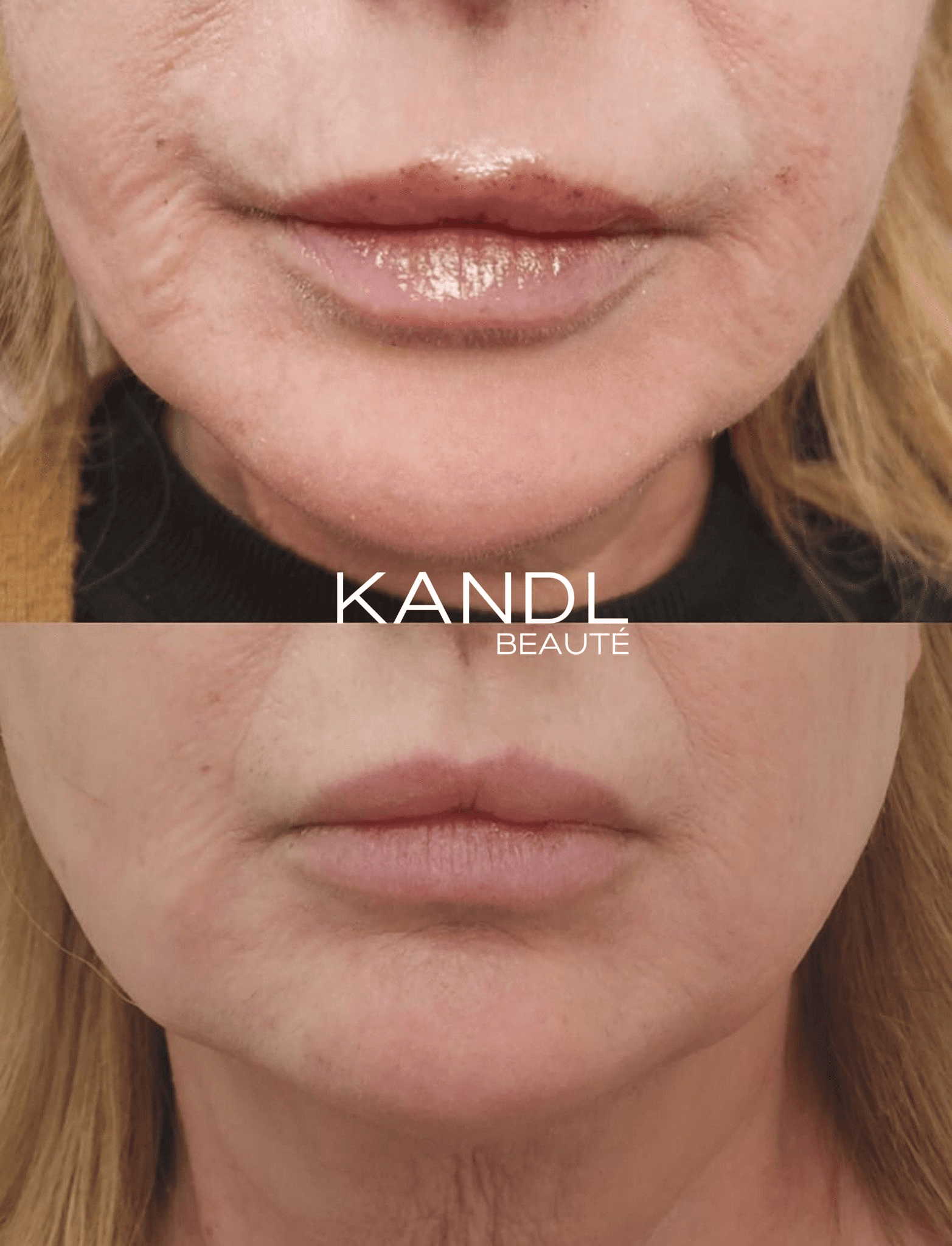 Joy-Microneedling In Montreal