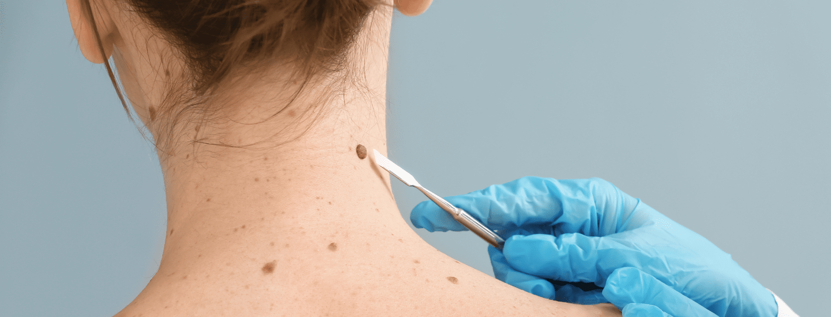 skin tag wart removal